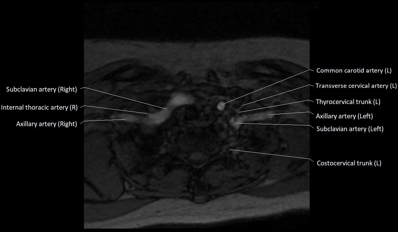 Carotid artery anatomy axial 3T image 69.jpg